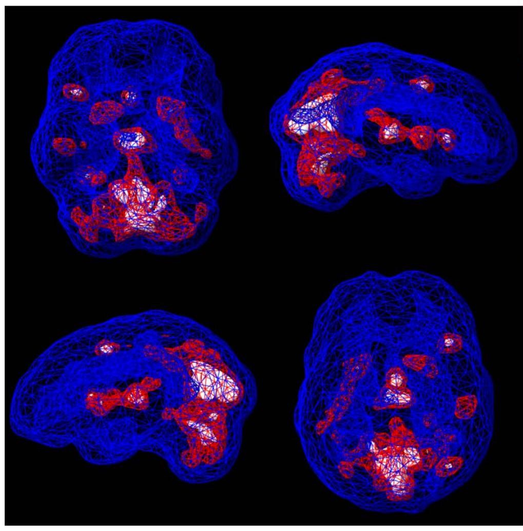 De-identified SPECT scan showing active three-dimensional brain patterns